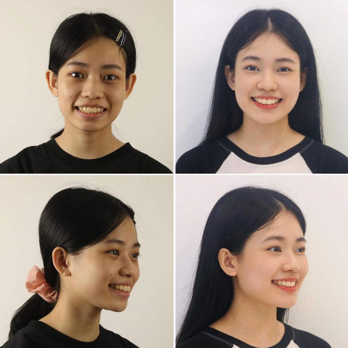 Chỉnh nha chính là phương pháp giúp khắc phục nhiều vấn đề về răng