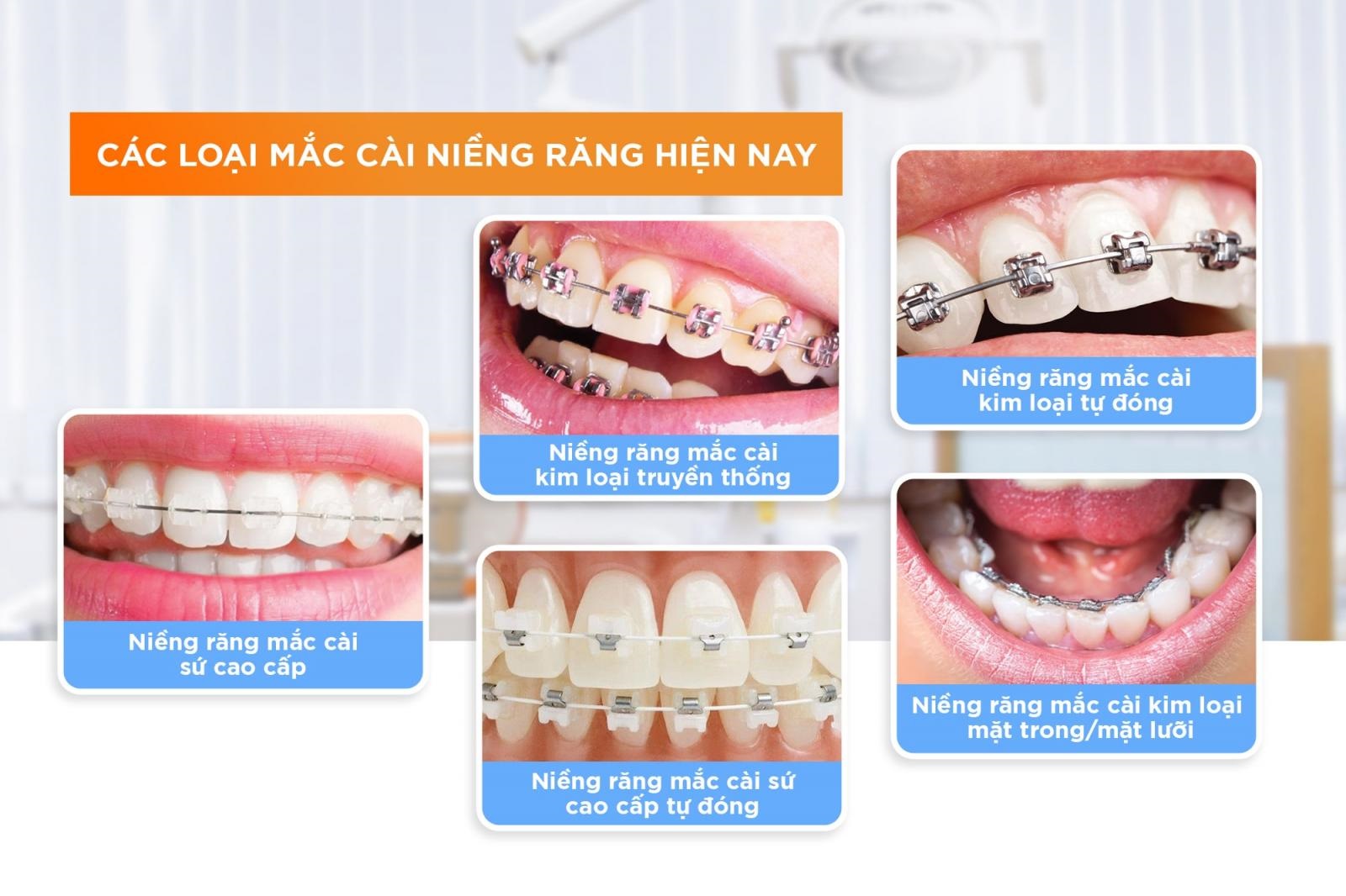 Mỗi một phương pháp chỉnh nha sẽ có những ưu điểm khác nhau