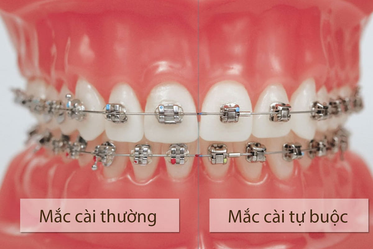 Mắc cài sứ tự buộc được dùng để niềng răng