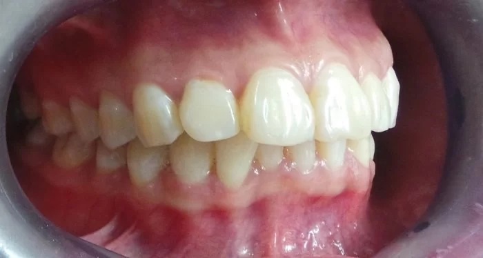 Hô răng là tình trạng hàm răng phía trên bị chìa ra quá mức so với hàm dưới